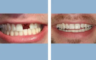 Tooth implant before and after result 5 - dental implant treatment in India, IndiCure patient