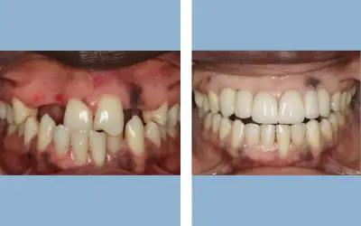 Tooth implant before and after result 6 - dental implant treatment in India, IndiCure patient