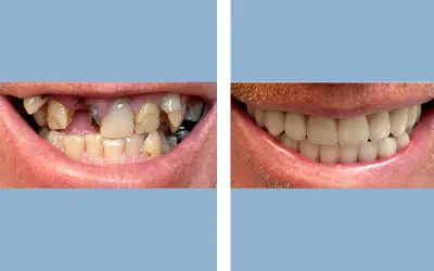 Tooth implant before and after result 7 - dental implant treatment in India, IndiCure patient