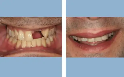 Tooth implant before and after result 8 - dental implant treatment in India, IndiCure patient
