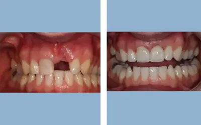 Tooth implant before and after result 9 - dental implant treatment in India, IndiCure patient