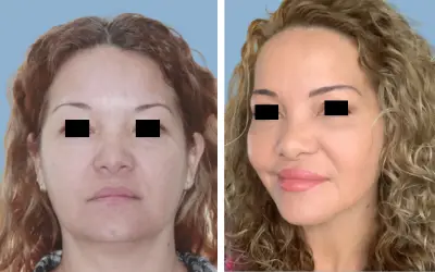 Facelift before and after result 1 - face lift surgery in India, IndiCure patient