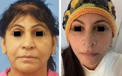 Facelift before and after result 10 - face lift  surgery in India, IndiCure patient