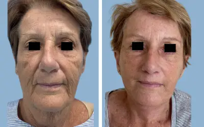 Facelift before and after result 11 - face lift  surgery in India, IndiCure patient