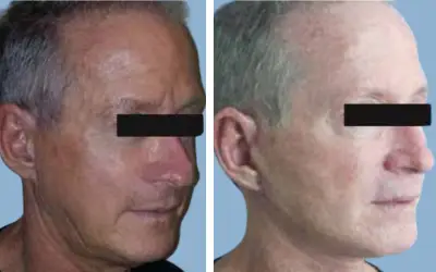 Facelift before and after result 12 - face lift  surgery in India, IndiCure patient