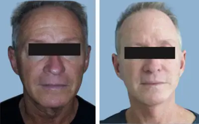 Facelift before and after result 13 - face lift  surgery in India, IndiCure patient