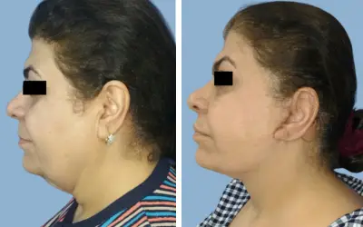 Facelift before and after result 14 - face lift  surgery in India, IndiCure patient