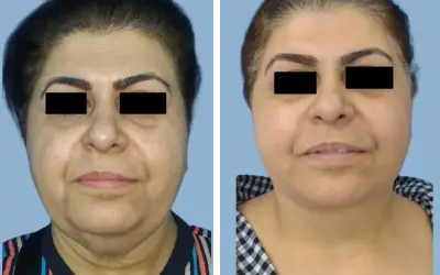 Facelift before and after result 15 - face lift  surgery in India, IndiCure patient