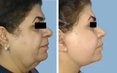 Facelift before and after result 16 - face lift  surgery in India, IndiCure patient