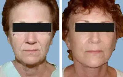 Facelift before and after result 17 - face lift  surgery in India, IndiCure patient