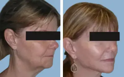 Facelift before and after result 18 - face lift  surgery in India, IndiCure patient