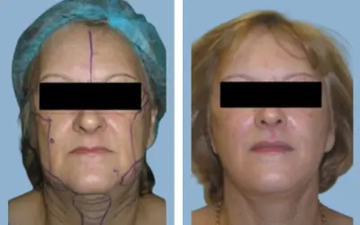 Facelift before and after result 19 - face lift  surgery in India, IndiCure patient