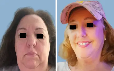 Facelift before and after result 2 - face lift  surgery in India, IndiCure patient