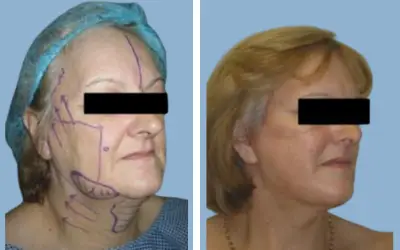 Facelift before and after result 20 - face lift  surgery in India, IndiCure patient