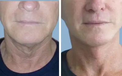 Facelift before and after result 21 - face lift  surgery in India, IndiCure patient