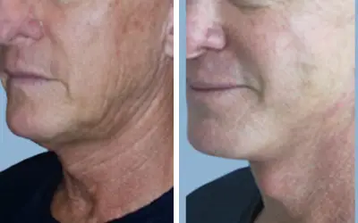Facelift before and after result 22 - face lift  surgery in India, IndiCure patient