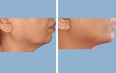 Facelift before and after result 23 - face lift  surgery in India, IndiCure patient