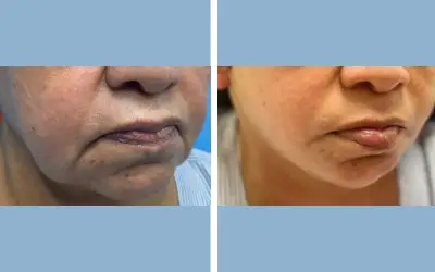 Facelift before and after result 24 - face lift  surgery in India, IndiCure patient