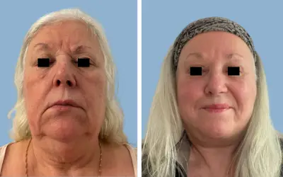 Facelift before and after result 3 - face lift  surgery in India, IndiCure patient