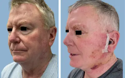 Facelift before and after result 4 - face lift  surgery in India, IndiCure patient