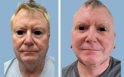 Facelift before and after result 5 - face lift  surgery in India, IndiCure patient