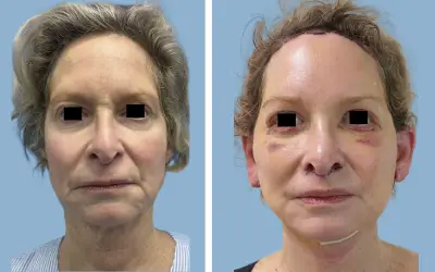 Facelift before and after result 6 - face lift  surgery in India, IndiCure patient