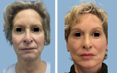 Facelift before and after result 7 - face lift  surgery in India, IndiCure patient
