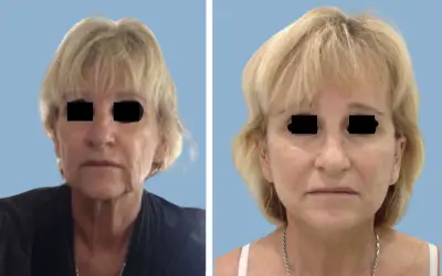 Facelift before and after result 8 - face lift  surgery in India, IndiCure patient
