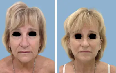 Facelift before and after result 9 - face lift  surgery in India, IndiCure patient