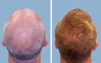 FUE hair transplant before and after result 1 - follicular unit extraction in India, IndiCure patient