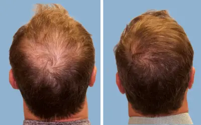 FUE hair transplant before and after result 3 - follicular unit extraction in India, IndiCure patient