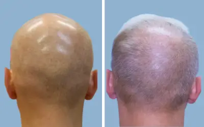 FUE hair transplant before and after result 4 - follicular unit extraction in India, IndiCure patient