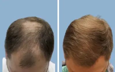 FUE hair transplant before and after result 5 - follicular unit extraction in India, IndiCure patient