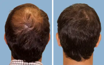 FUE hair transplant before and after result 6 - follicular unit extraction in India, IndiCure patient
