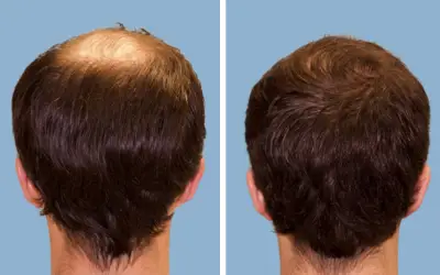 FUE hair transplant before and after result 7 - follicular unit extraction in India, IndiCure patient