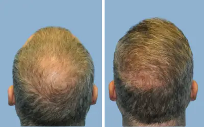 FUE hair transplant before and after result 8 - follicular unit extraction in India, IndiCure patient