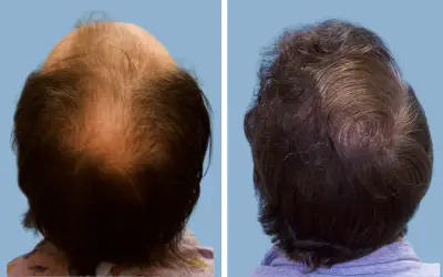 FUE hair transplant before and after result 9 - follicular unit extraction in India, IndiCure patient