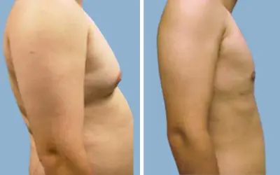 Gynecomastia surgery before and after result 1 - male breast reduction in India, IndiCure patient