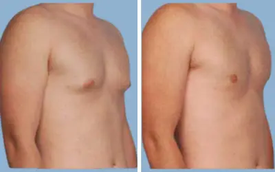 Gynecomastia surgery before and after result 10 - male breast reduction in India, IndiCure patient