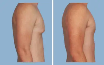 Gynecomastia surgery before and after result 11 - male breast reduction in India, IndiCure patient