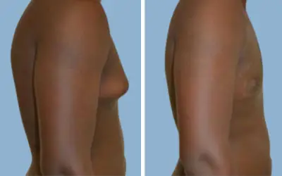 Gynecomastia surgery before and after result 12 - male breast reduction in India, IndiCure patient