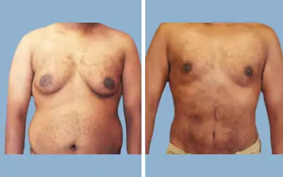 Gynecomastia surgery before and after result 13 - male breast reduction in India, IndiCure patient