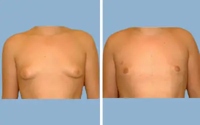 Gynecomastia surgery before and after result 14 - male breast reduction in India, IndiCure patient
