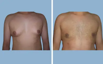Gynecomastia surgery before and after result 2 - male breast reduction in India, IndiCure patient