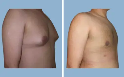 Gynecomastia surgery before and after result 3 - male breast reduction in India, IndiCure patient