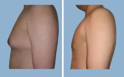Gynecomastia surgery before and after result 4 - male breast reduction in India, IndiCure patient