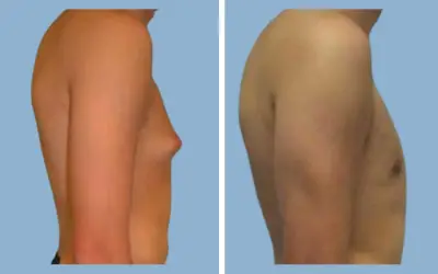 Gynecomastia surgery before and after result 5 - male breast reduction in India, IndiCure patient