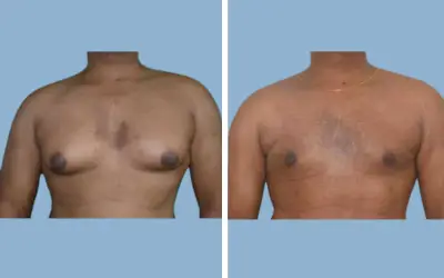 Gynecomastia surgery before and after result 6 - male breast reduction in India, IndiCure patient