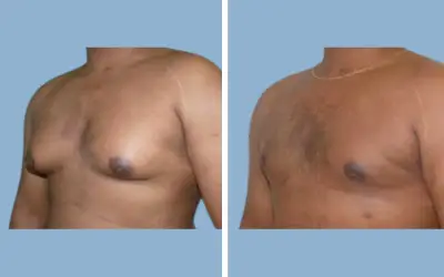 Gynecomastia surgery before and after result 7 - male breast reduction in India, IndiCure patient