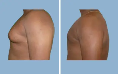 Gynecomastia surgery before and after result 8 - male breast reduction in India, IndiCure patient